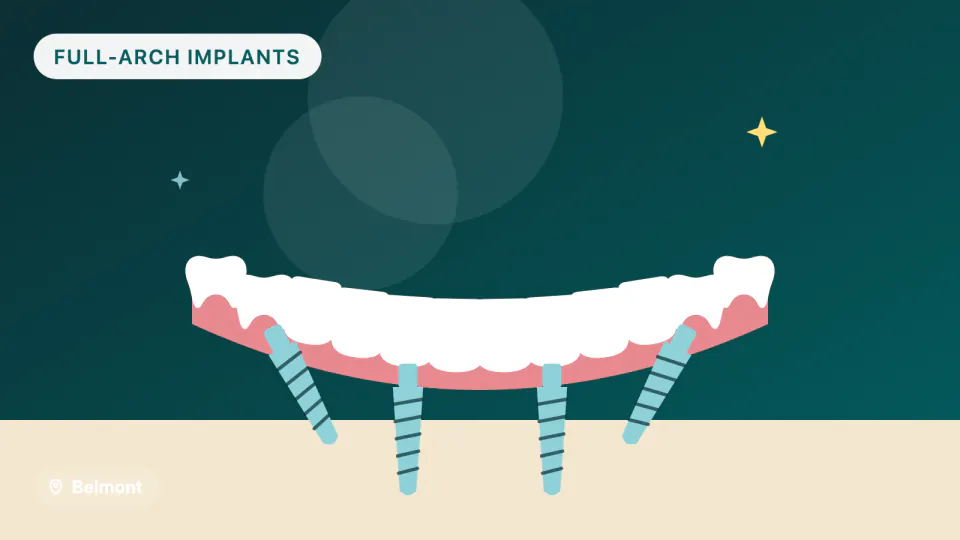 All-on-4 Implants in Belmont, CA: Materials, Timeline, Longevity