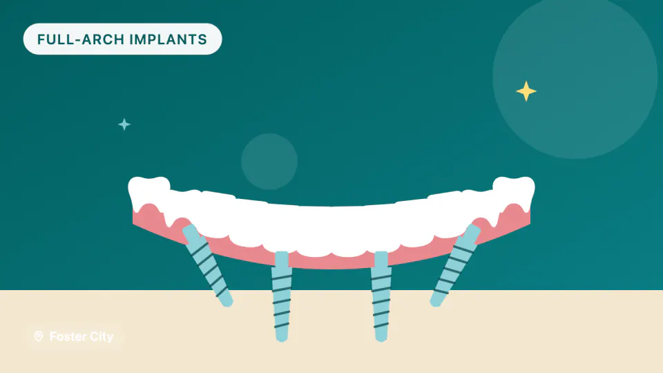 All-on-4 Implants in Foster City, CA: Materials & Timeline