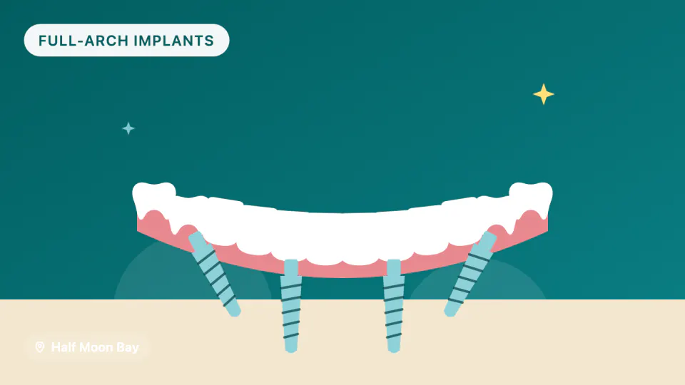 All-on-4 Implants for Half Moon Bay Patients: Timeline & Materials