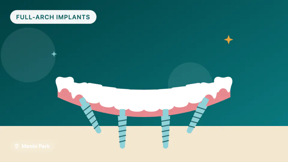 All-on-4 Implants in Menlo Park, CA: Materials, Timeline & Durability
