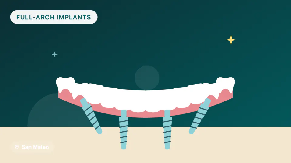 All-on-4 Implants in San Mateo: Timeline, Materials, Durability