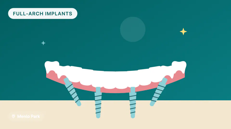 All-on-4 in Menlo Park: Zirconia vs Acrylic Full-Arch Teeth
