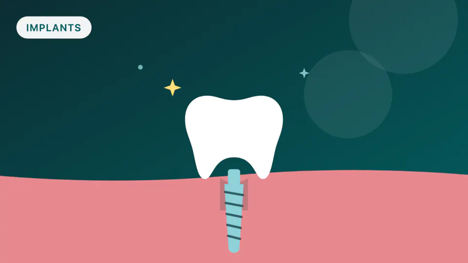 Bleeding Gums Around an Implant: Mucositis Is the Warning Stage