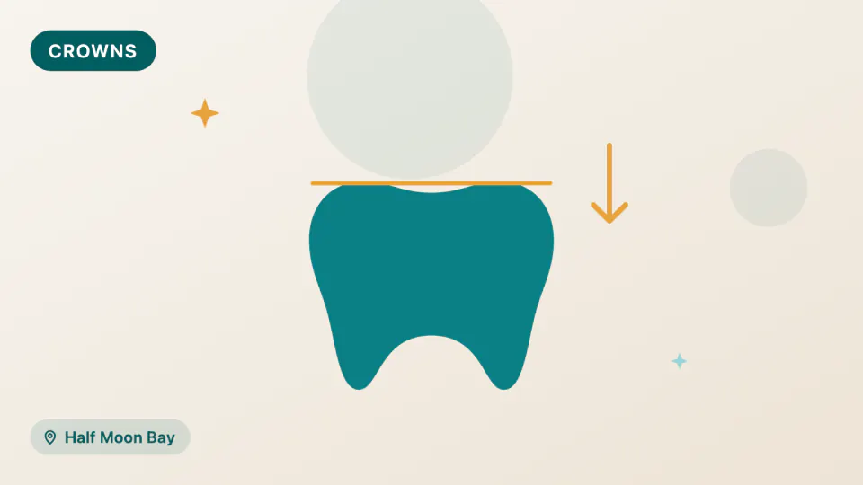 Dental Crowns in Half Moon Bay: Zirconia, Lithium Disilicate or 3D-Printed?