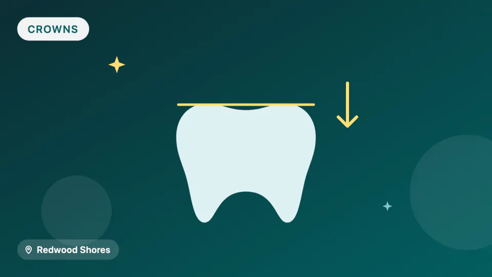 Dental Crowns in Redwood Shores: Zirconia, Lithium Disilicate or 3D-Printed?
