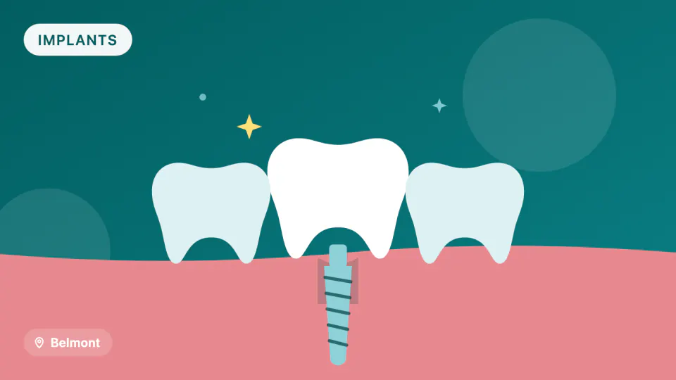 Dental Implant Maintenance in Belmont, CA: Why Recalls Matter