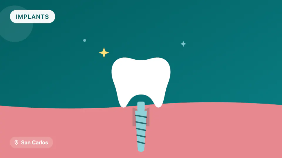 Dental Implant Maintenance in San Carlos: Why Recalls Matter