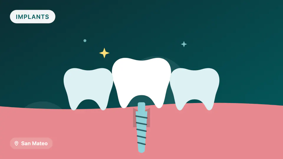 Dental Implant Maintenance in San Mateo, CA: Why Follow-Up Matters