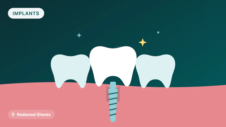 Dental Implants for Redwood Shores Patients: Screening & Success