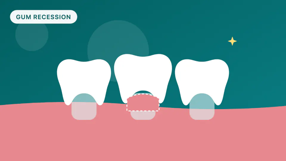 Gum Graft Without Palate Tissue? Collagen Matrix vs Autograft