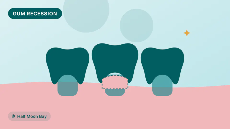 Receding Gums in Half Moon Bay: Gum Grafting Options & What to Expect
