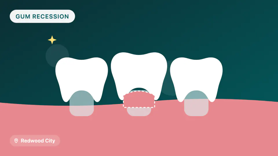 Receding Gums in Redwood City: Gum Grafting Options & Results