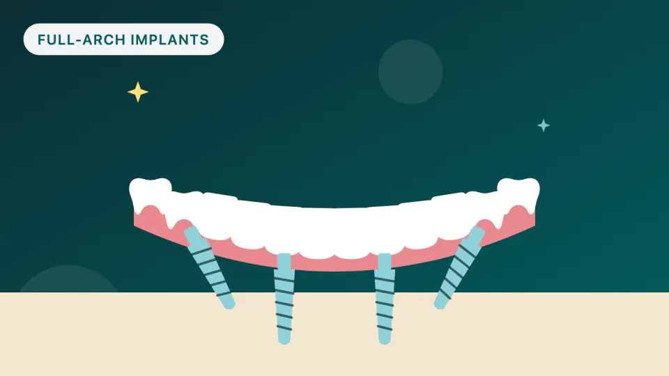 How Long Does a Zirconia Full-Arch Implant Bridge Last?
