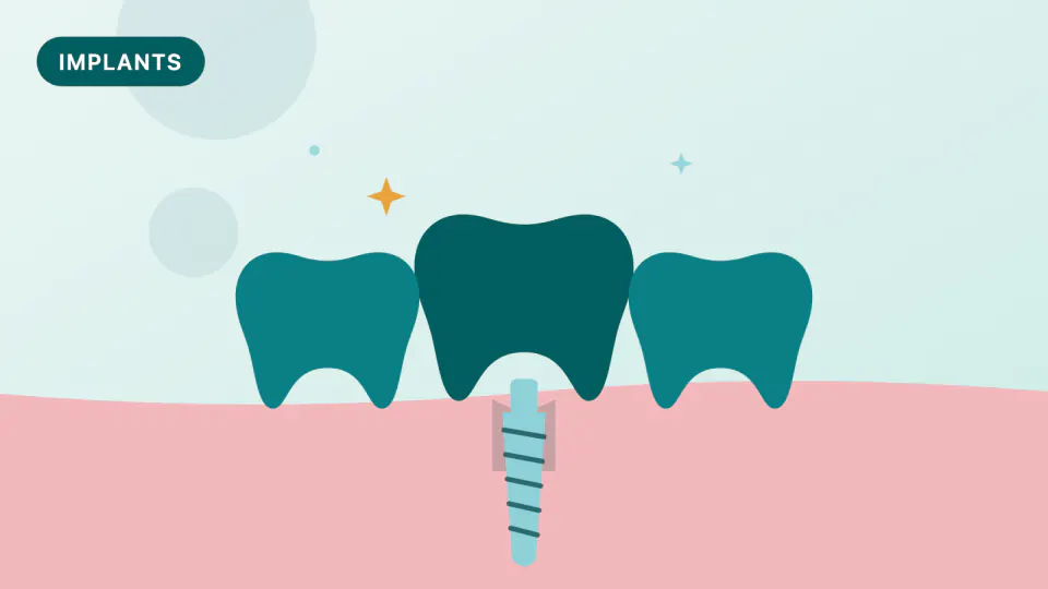 Immediate Implant After an Infected Tooth: What Research Shows