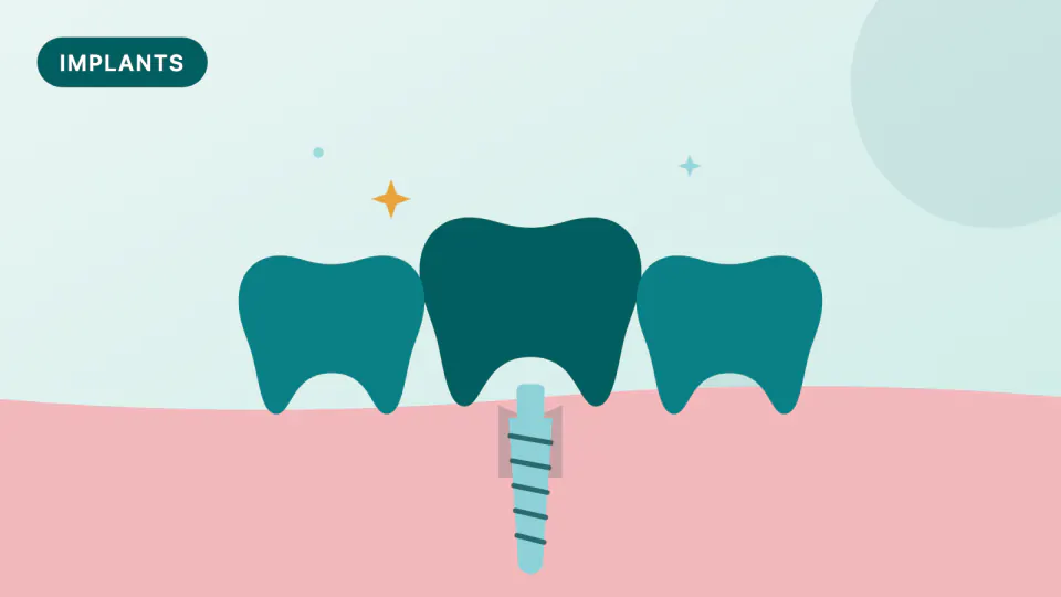 Implant Bridge Problems: Screw Loosening & Chipping Fixes