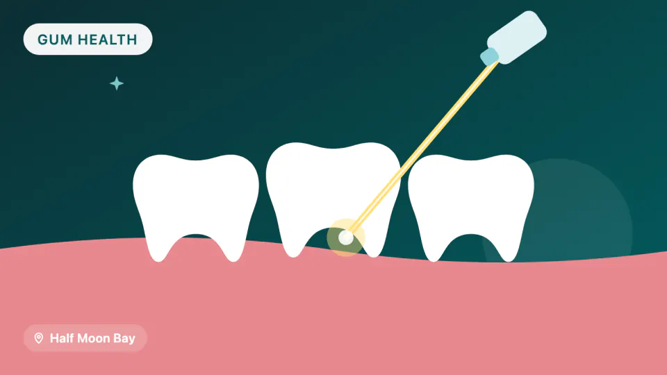 LANAP Laser Gum Treatment for Half Moon Bay Patients