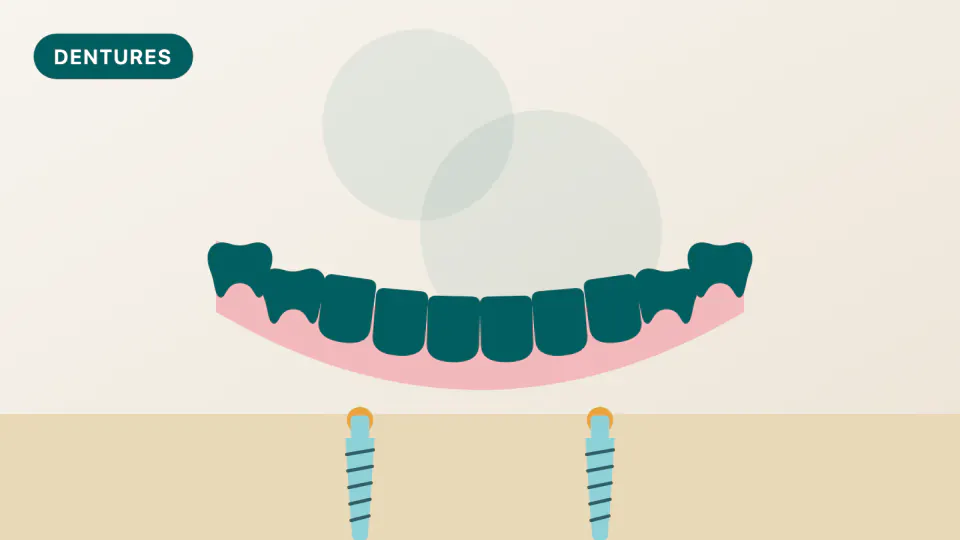 Dentures and Partials with HPSM Medi-Cal: Brisbane Guide