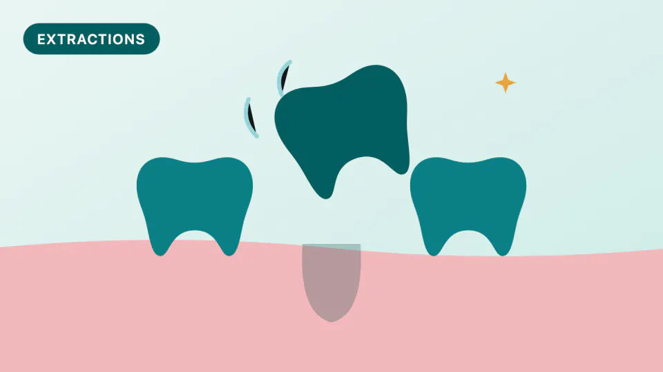 Tooth Extractions on HPSM Medi-Cal: San Bruno Patient Guide