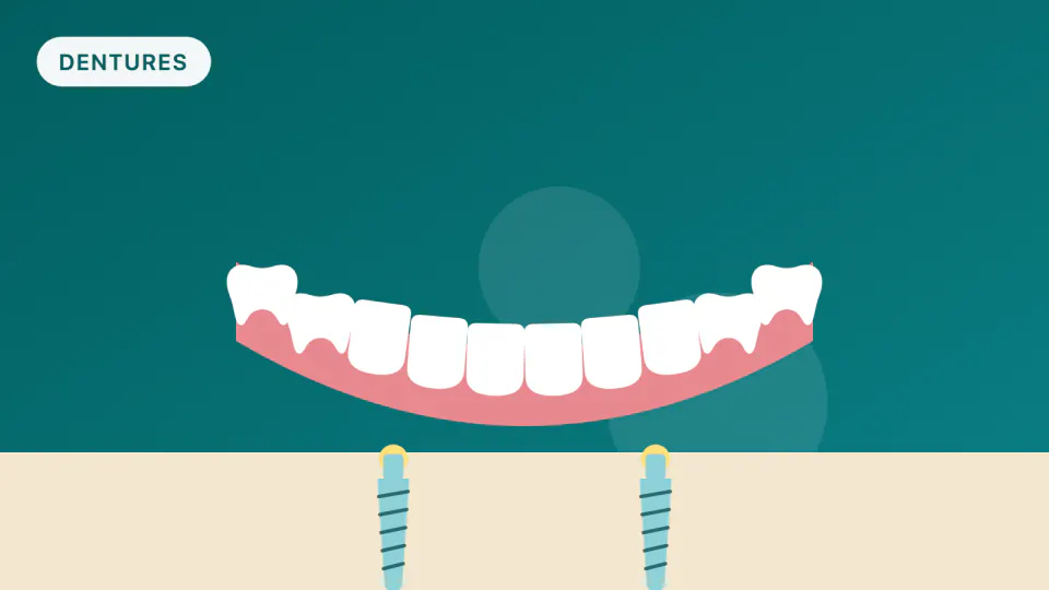 Mini Implants for Loose Dentures: Who They Suit & What Breaks