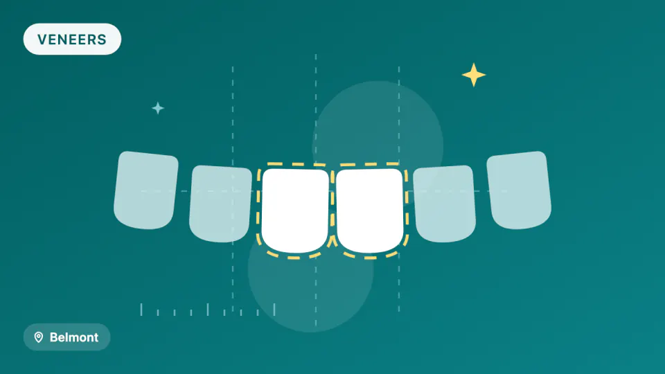 Porcelain Veneers in Belmont, CA: 10-Year Survival Data Explained