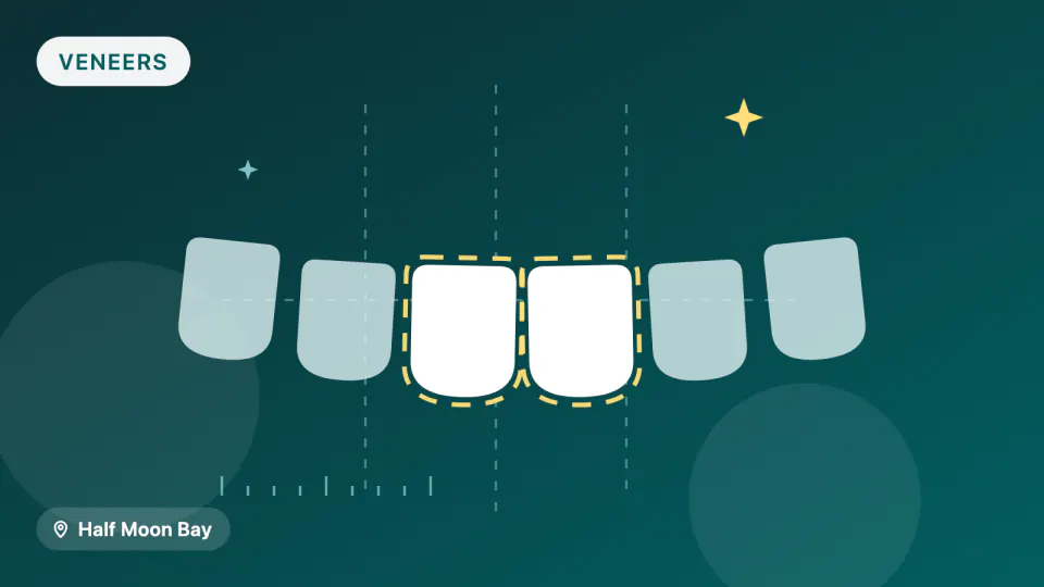 Porcelain Veneers in Half Moon Bay, CA: How Long They Really Last