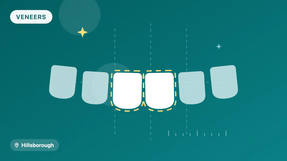 Porcelain Veneers in Hillsborough: 10-Year Survival Data