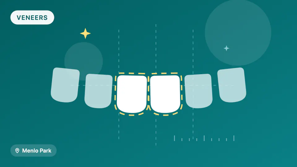 Porcelain Veneers in Menlo Park: 10-Year Survival Data