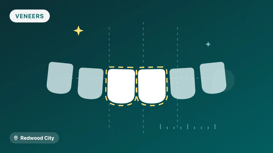 Porcelain Veneers in Redwood City: 10-Year Survival Data
