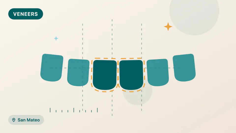 Porcelain Veneers in San Mateo: 10-Year Survival Data Explained
