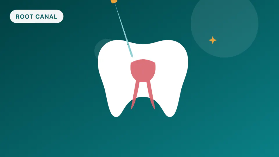 Root Canals with HPSM Medi-Cal: A Millbrae Guide
