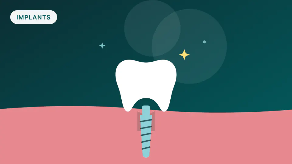 Screw-Retained vs. Cemented Implant Crowns: What Trials Show