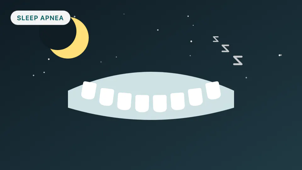 Sleep Apnea Mouthpieces and Bite Changes Over the Years