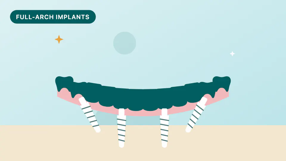 Smoking and Full-Arch Implants: How Much It Raises Risk