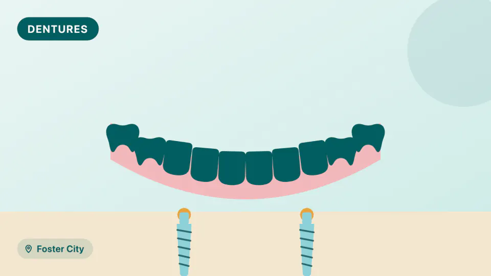 Snap-In Implant Dentures in Foster City: How Many Implants?
