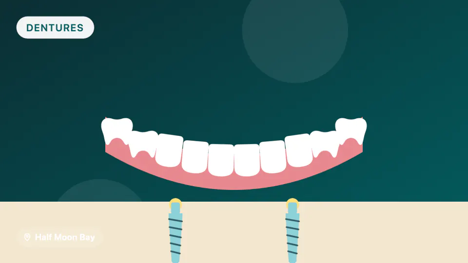 Snap-In Dentures in Half Moon Bay: How Many Implants Do You Need?