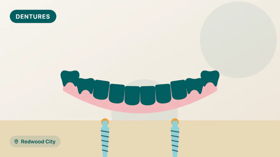 Snap-In Implant Dentures in Redwood City: How Many Implants?