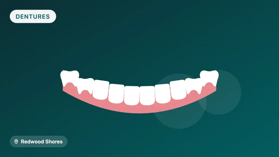 Snap-In Implant Dentures: How Many Implants Do You Need?