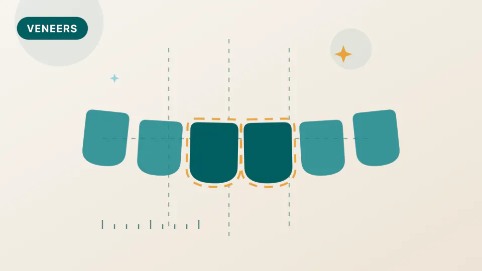 Zirconia vs. E.max Veneers: What Long-Term Data Shows