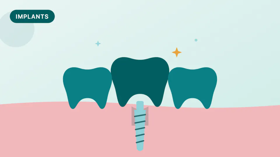 Zygomatic Implants: Fixed Teeth With Severe Upper Jaw Bone Loss