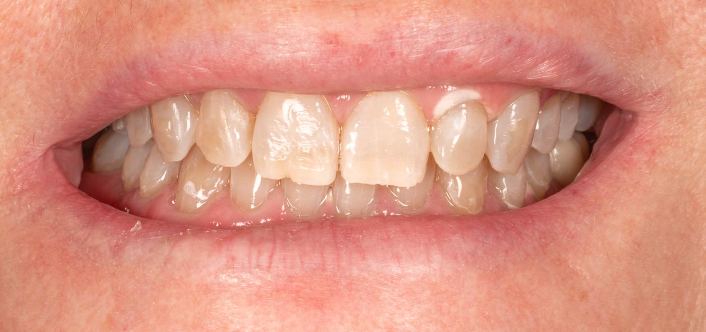 Smile after
