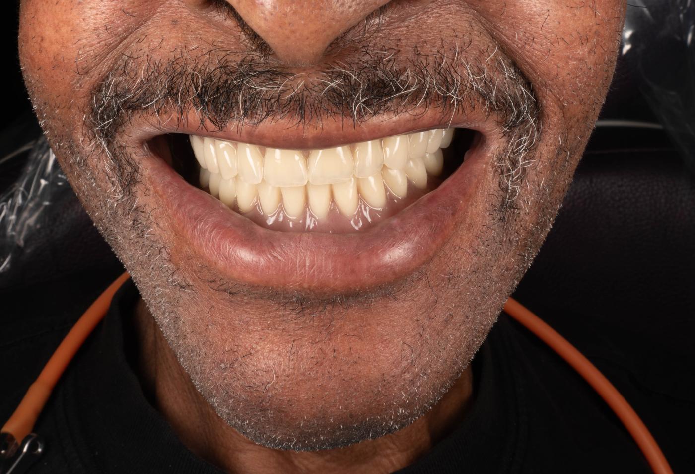 Smile after