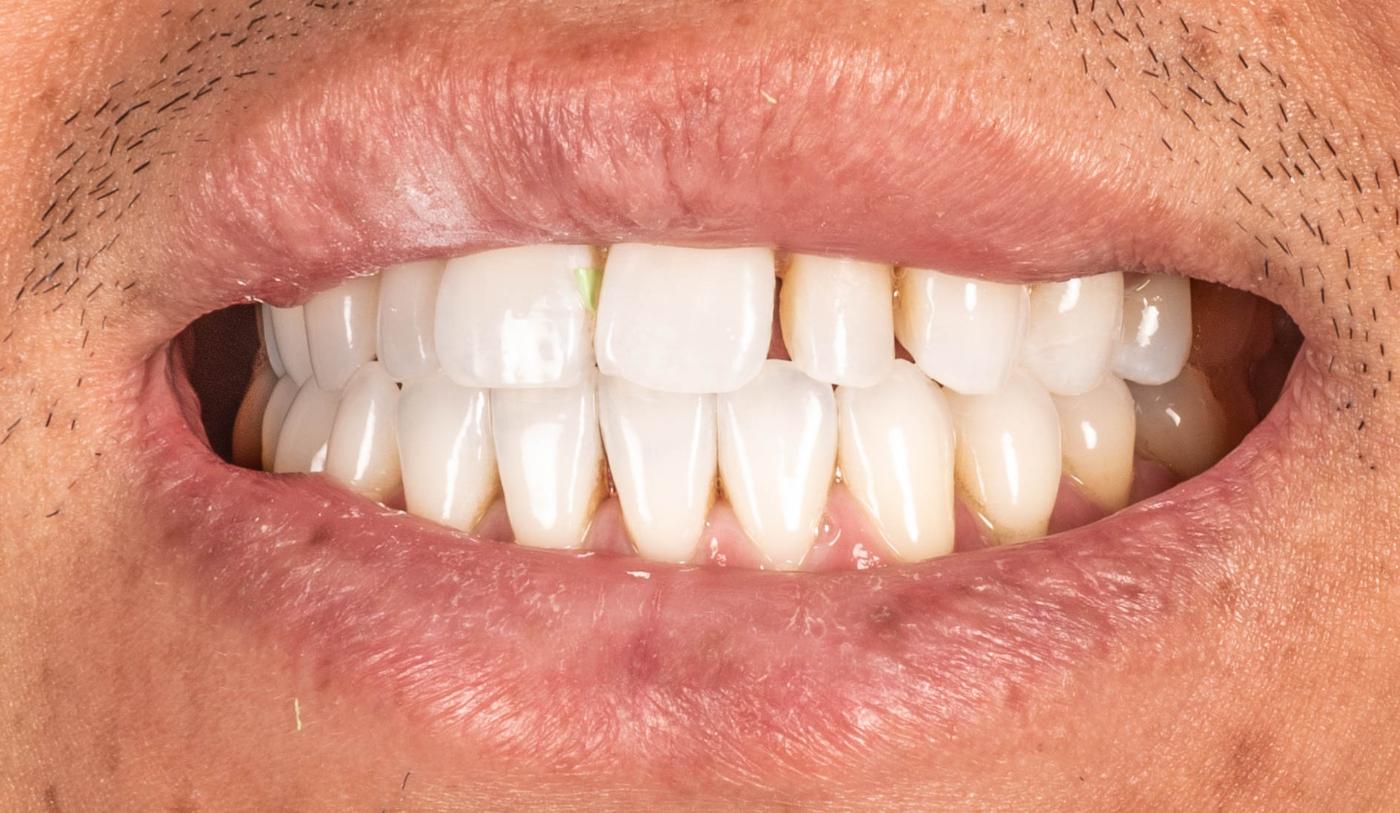 Smile before