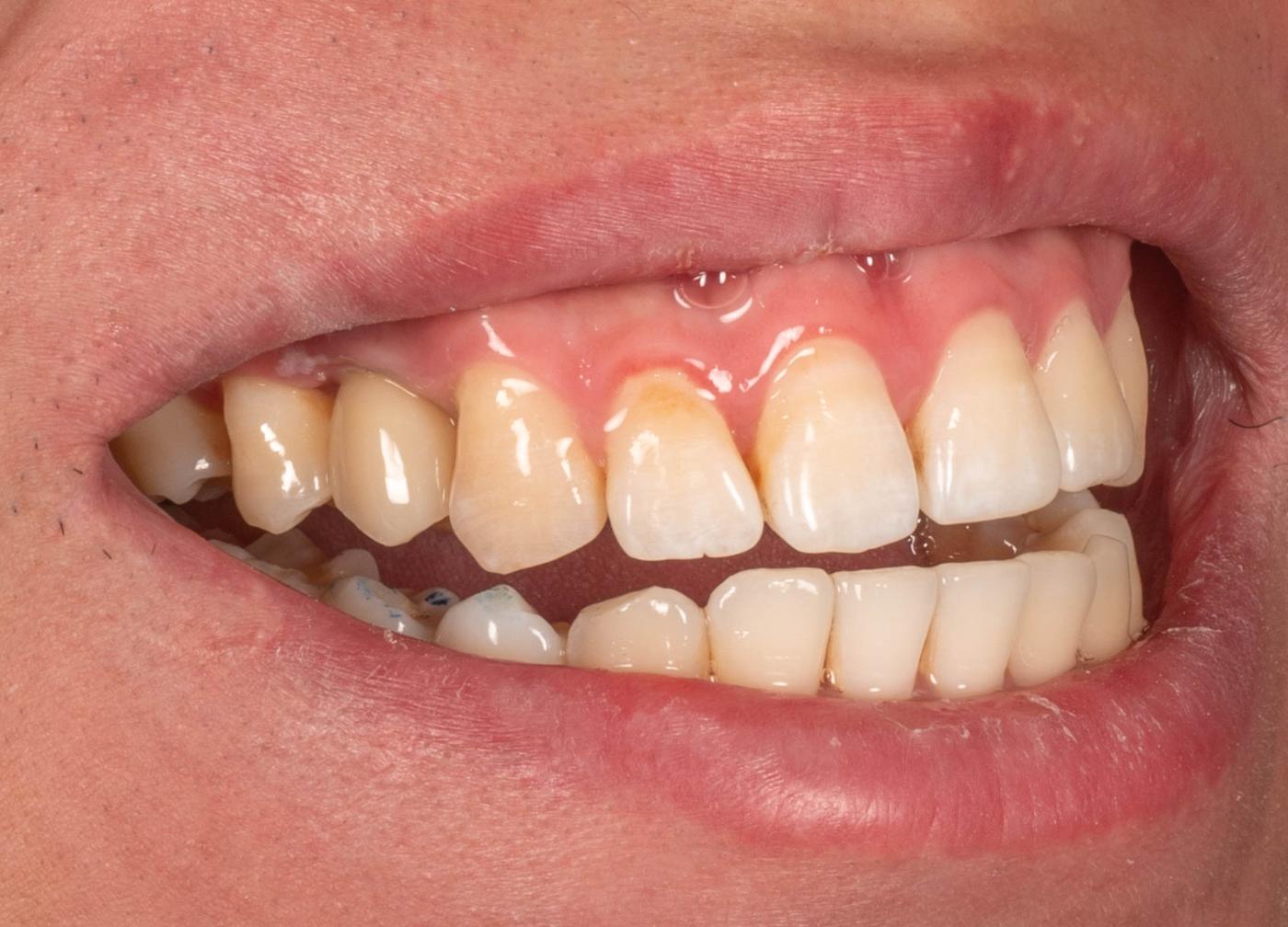 Smile after