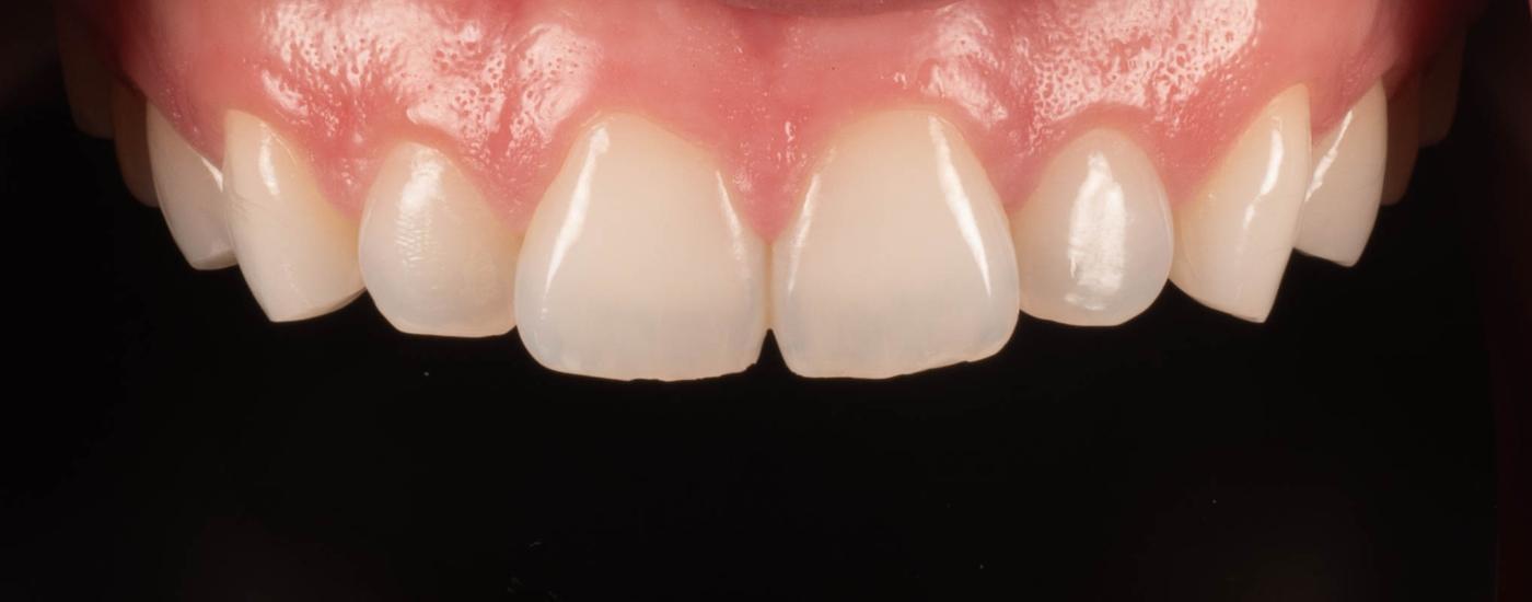 Smile after