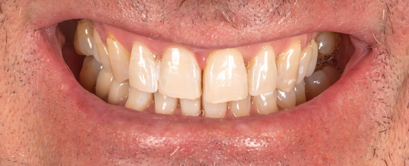 Smile after