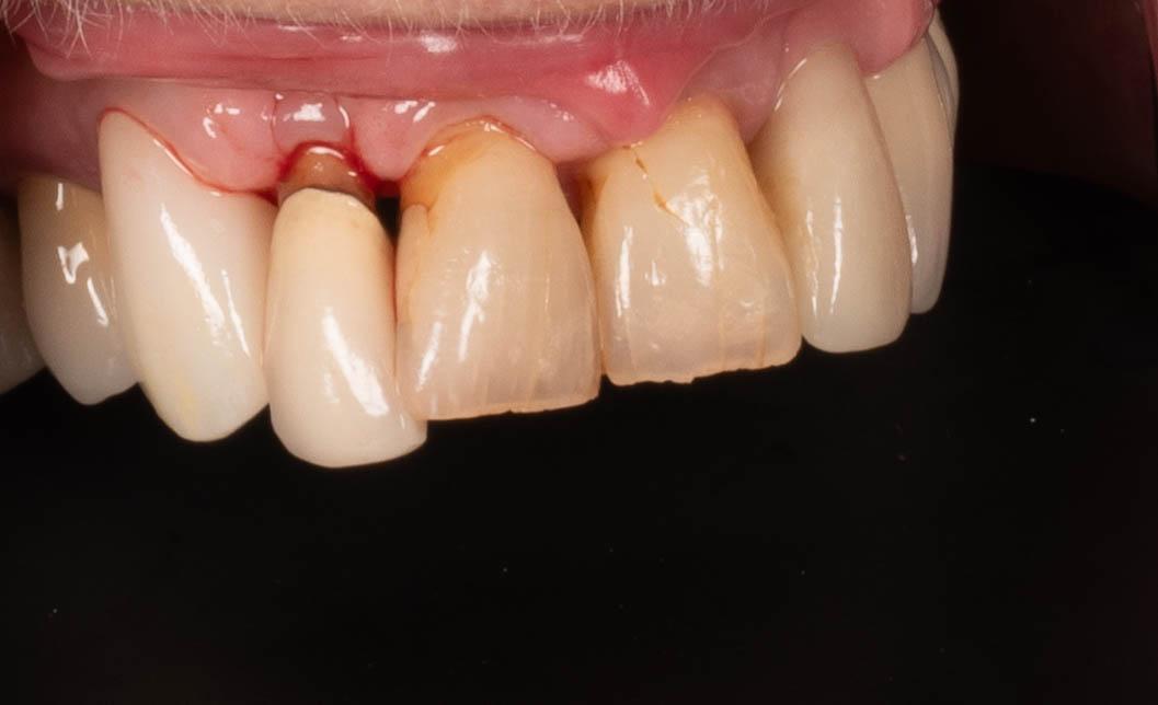 Smile before