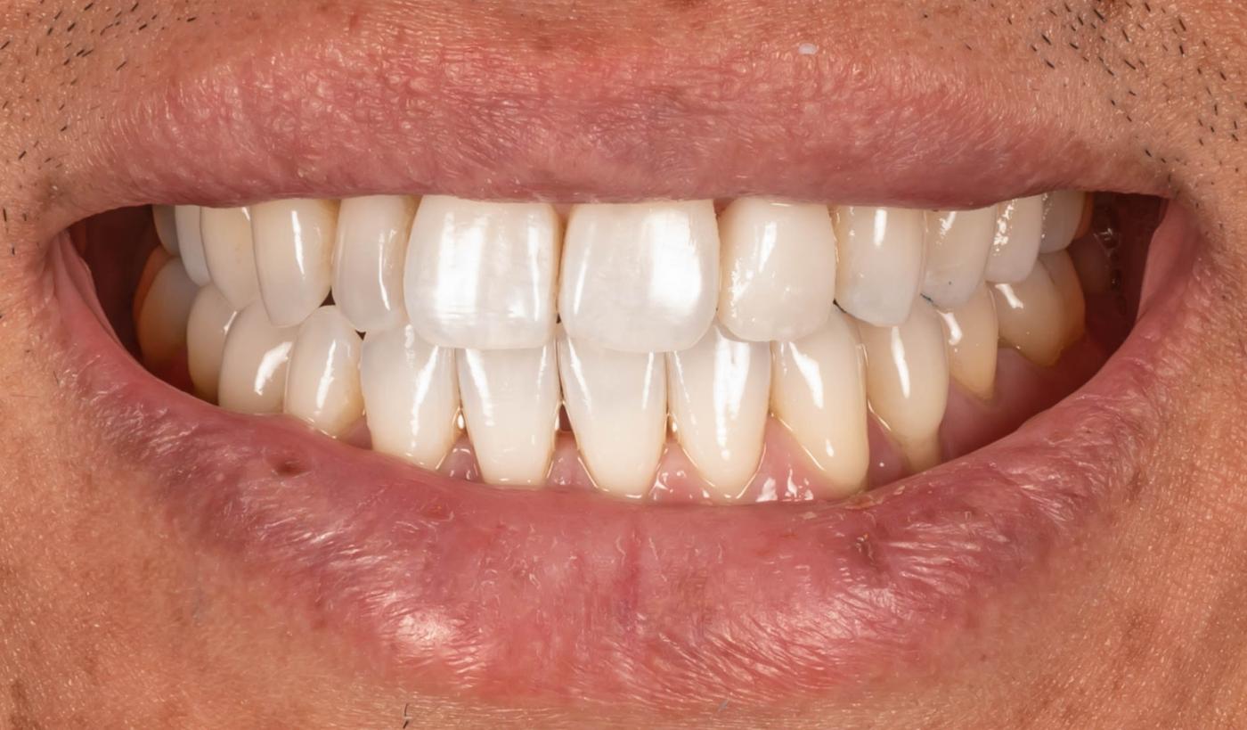 Smile after
